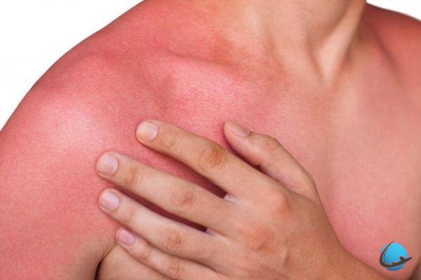 Tips for responding well to sunburn